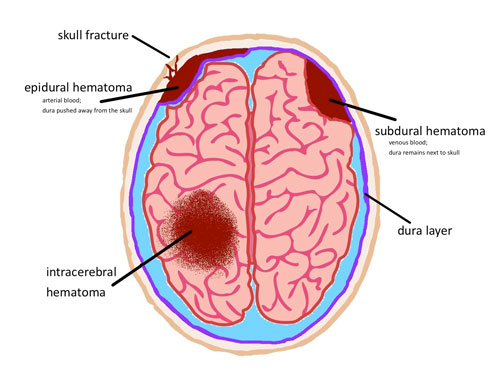 Brain Hemorrhage Surgery