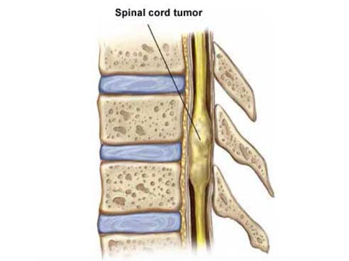 Spinal Cord Tumor Surgery in Jaipur