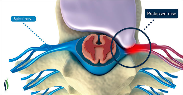 Disc Injury & Prolapse Surgery