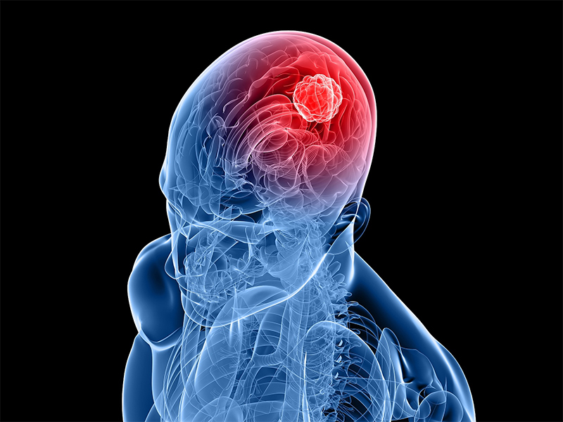 Brain Tumor Surgery in Jaipur